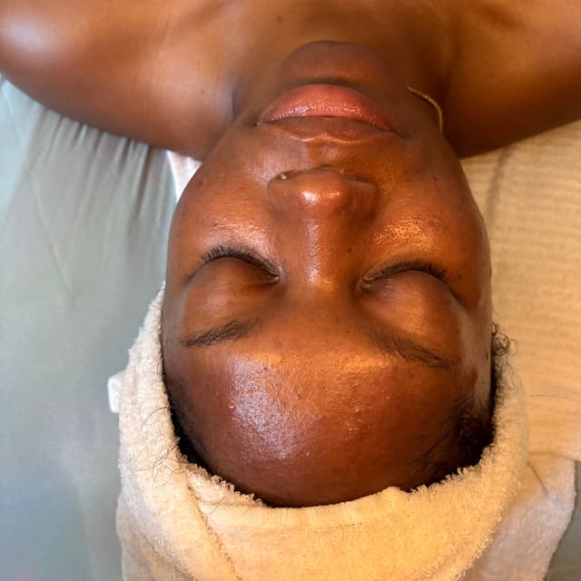 Acne Plan at Treasured Living Esthetics in Rosedale, MD